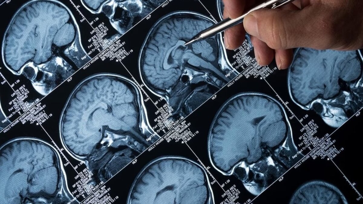 Suspected Amoebic Meningoencephalitis Claims Life of a 38-year-old man in Kerala