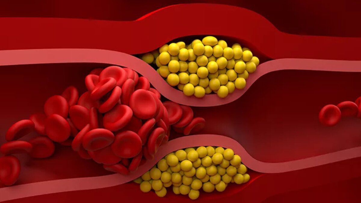 Manage Your Cholesterol: Foods You Should Stay Away From
