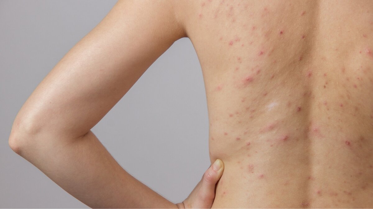Struggling with Body Acne? Try These 5 Effective Solutions