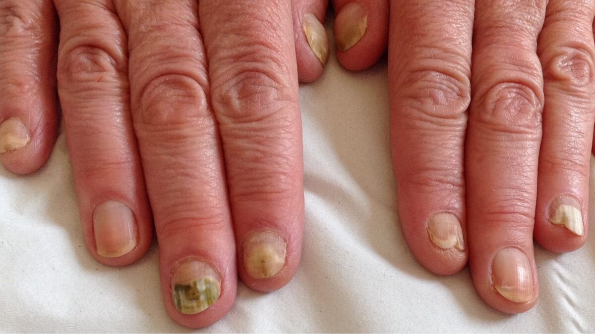 Nail infections: the real reasons they spread and how you can stop them