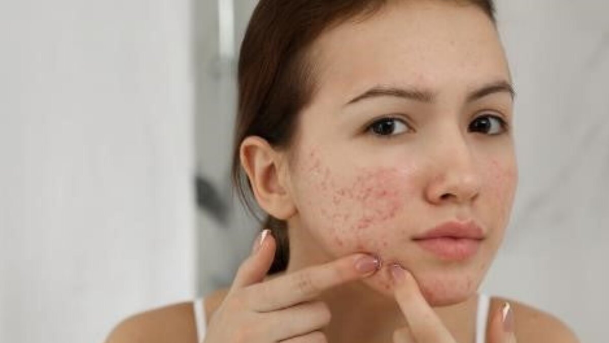Beat the Sun: Effective Ways to Prevent and Treat Sun-Induced Acne