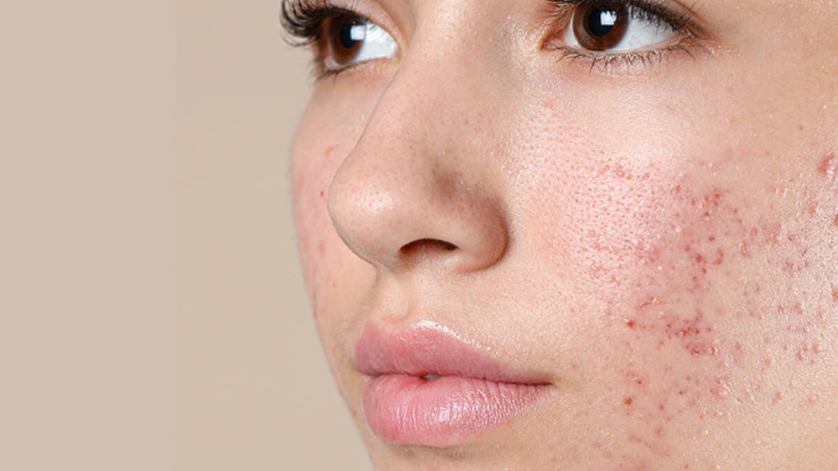 Does salicylic acid really work on acne? The science, benefits and safe usage tips