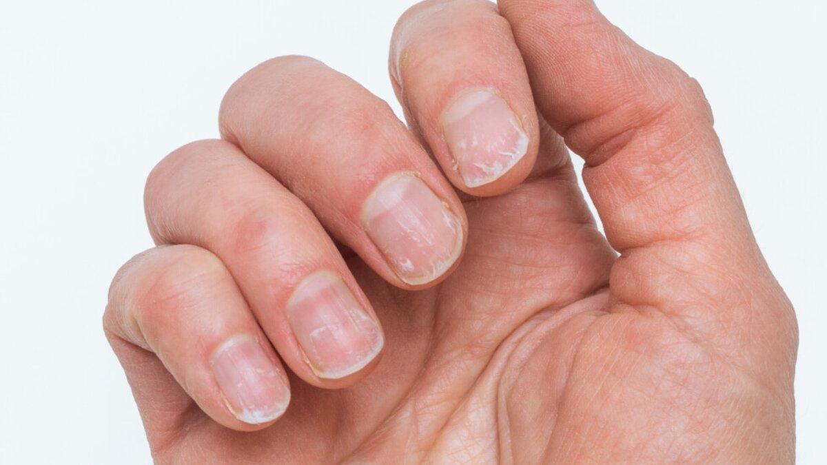 Say goodbye to brittle nails: top ways to prevent and reverse thinning nails