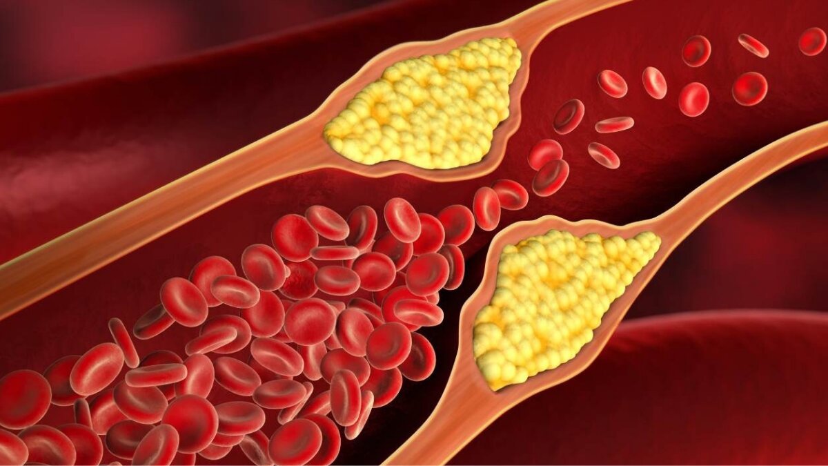 Why cholesterol builds up in the body and how to treat it naturally and medically