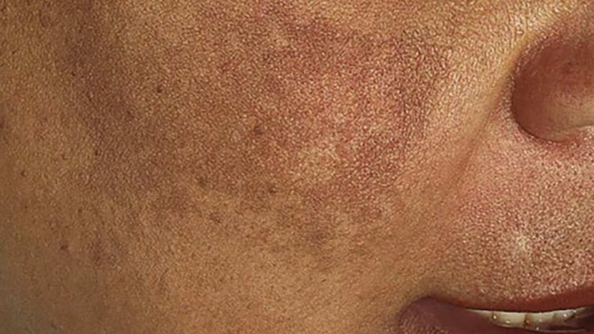 Why dark pigmentation happens on skin: causes, prevention and effective treatment options