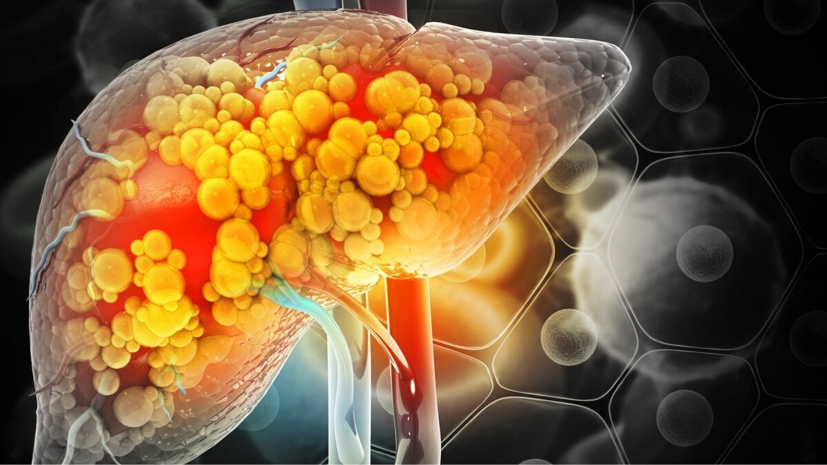 Lifestyle changes you must make to reverse fatty liver naturally and safely