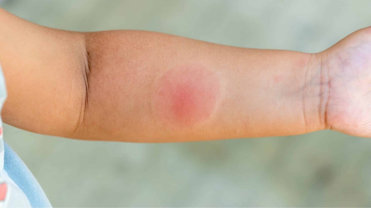 What to do if a spider bites you: Step-by-step home treatment and when to see a doctor