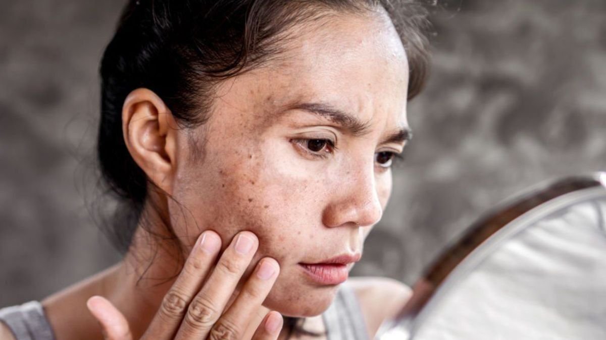 5 Effective ways to treat dark spots naturally and professionally